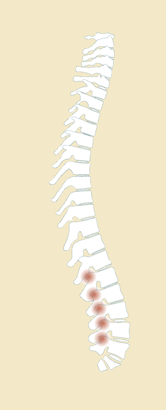 Spine diagram highlighting restricted lumbar facet joint mobility